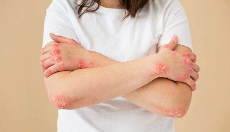 SLE / Lupus